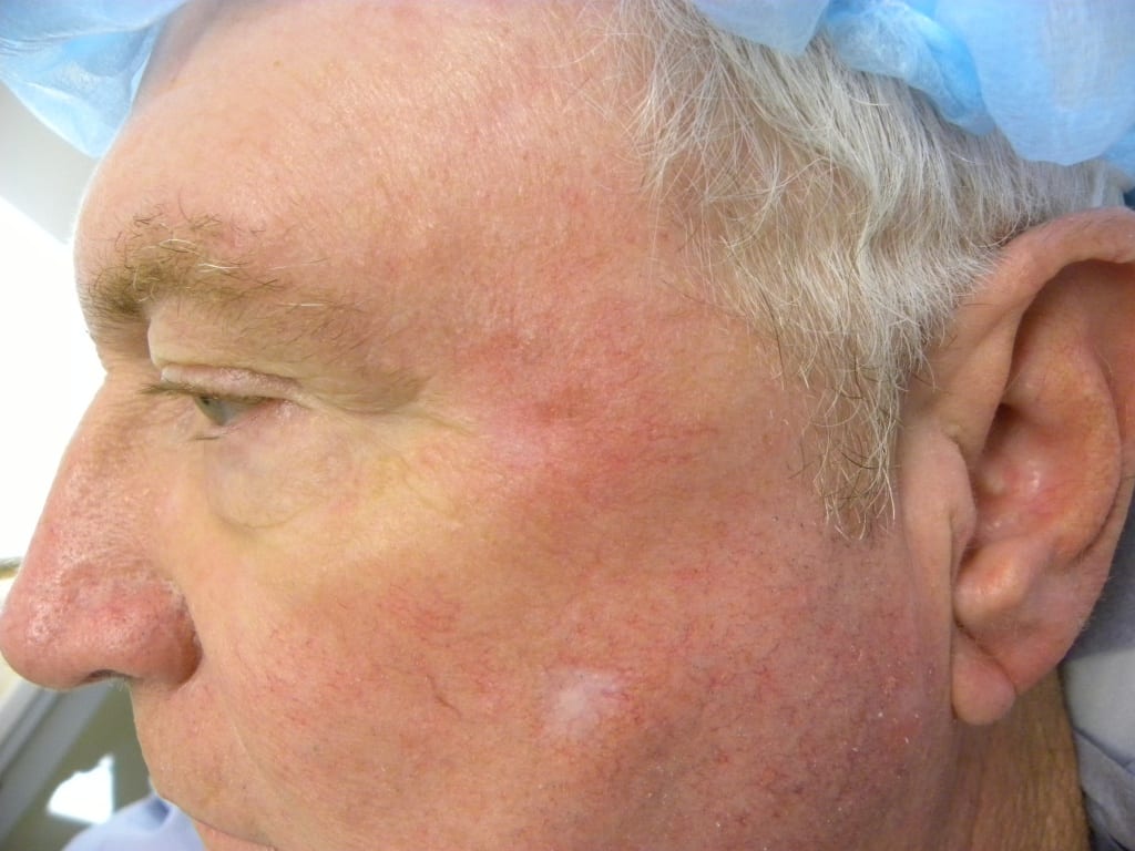 Skin Cancer Reconstruction for Men Before and After Pictures Miami, FL