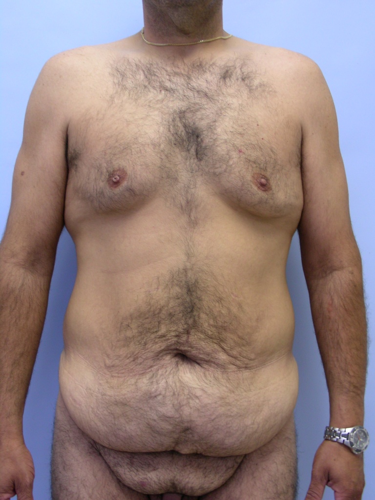 Male Tummy Tuck Before and After Pictures Miami, FL