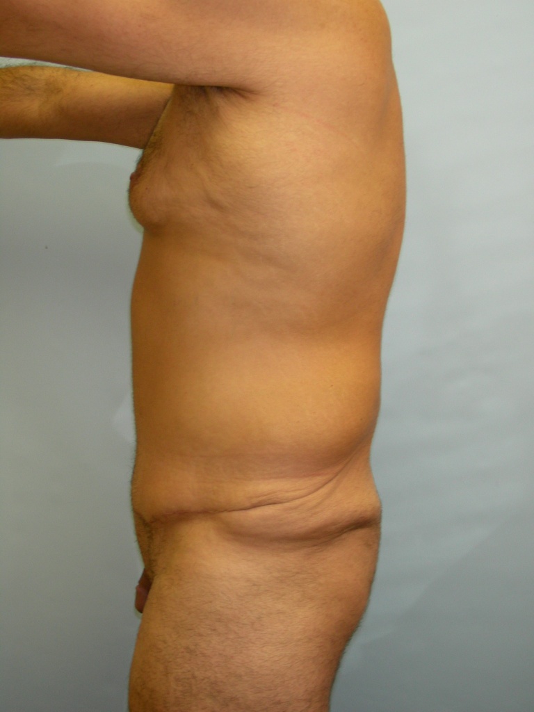 Male Tummy Tuck Before and After Pictures Miami, FL