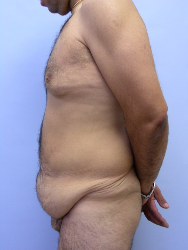 Male Tummy Tuck Before and After Pictures Miami, FL