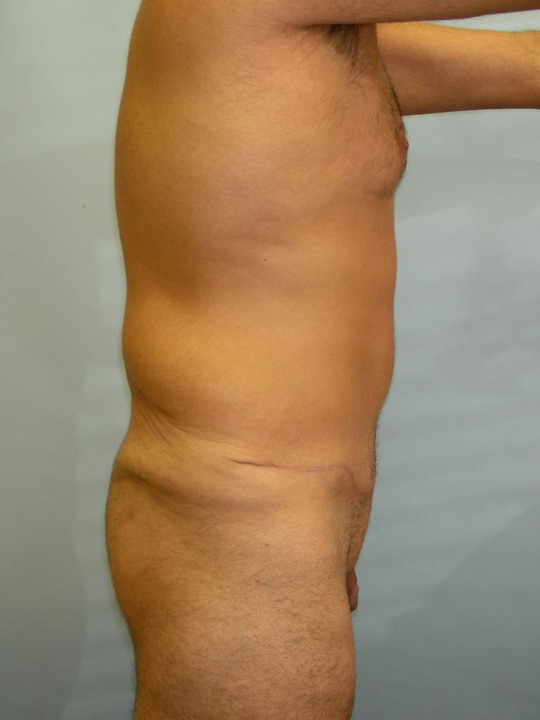 Male Tummy Tuck Before and After Pictures Miami, FL