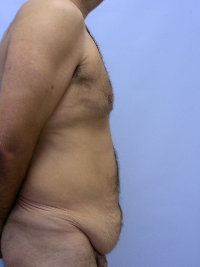 Male Tummy Tuck Before and After Pictures Miami, FL