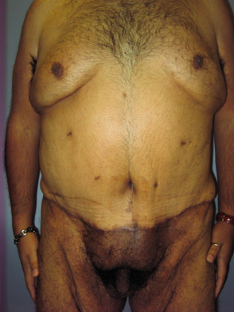 Male Tummy Tuck Before and After Pictures Miami, FL