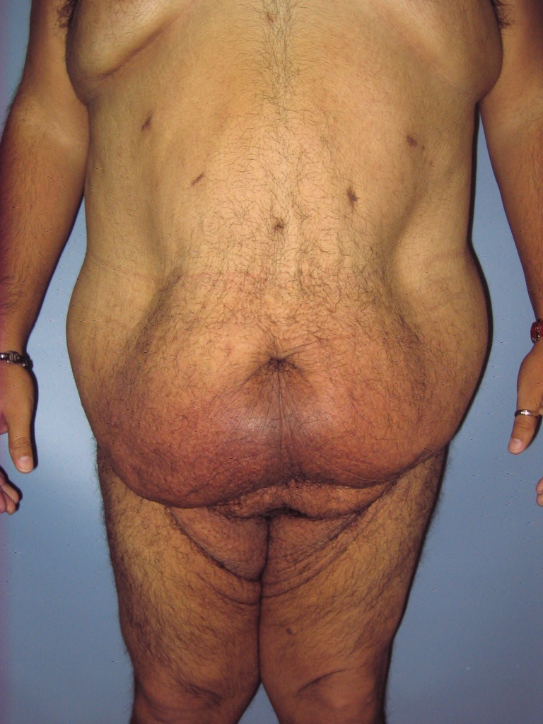 Male Tummy Tuck Before and After Pictures Miami, FL