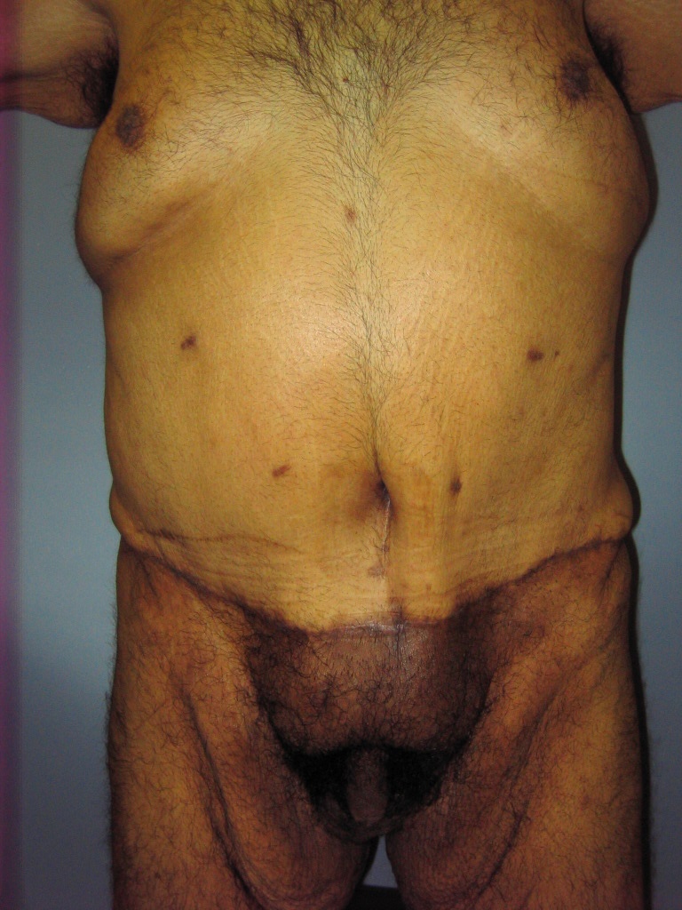 Male Tummy Tuck Before and After Pictures Miami, FL