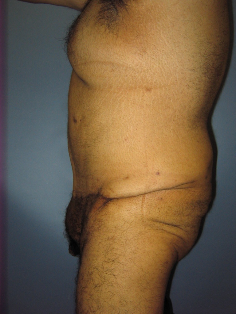 Male Tummy Tuck Before and After Pictures Miami, FL