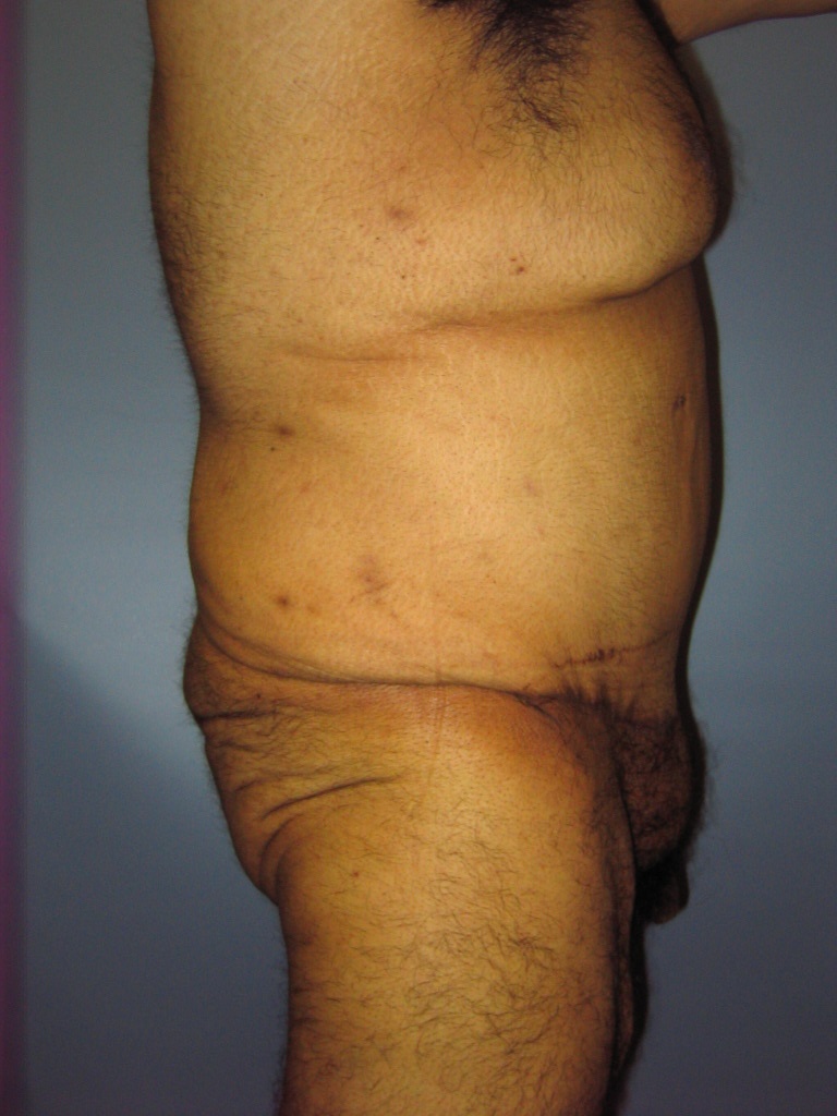 Male Tummy Tuck Before and After Pictures Miami, FL