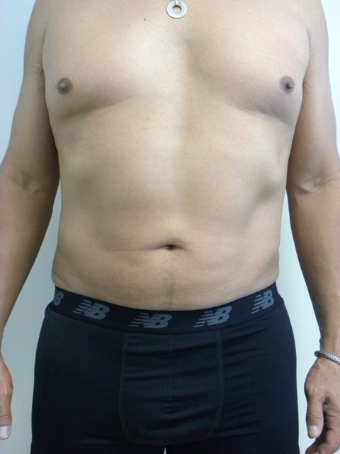 LIPOSUCTION BEFORE AND AFTER PICTURES IN MIAMI, FL