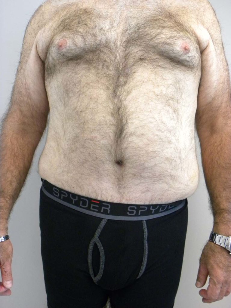 Tummy Tuck Before and After Pictures in Miami, FL