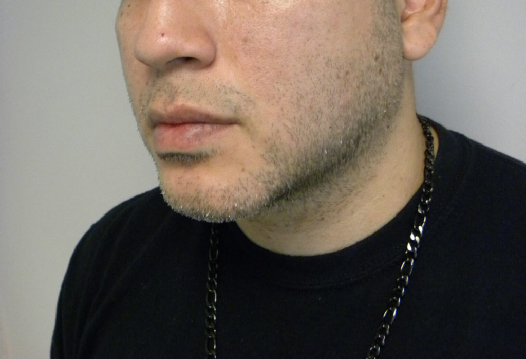 CHIN IMPLANT BEFORE AND AFTER PICTURES IN MIAMI, FL