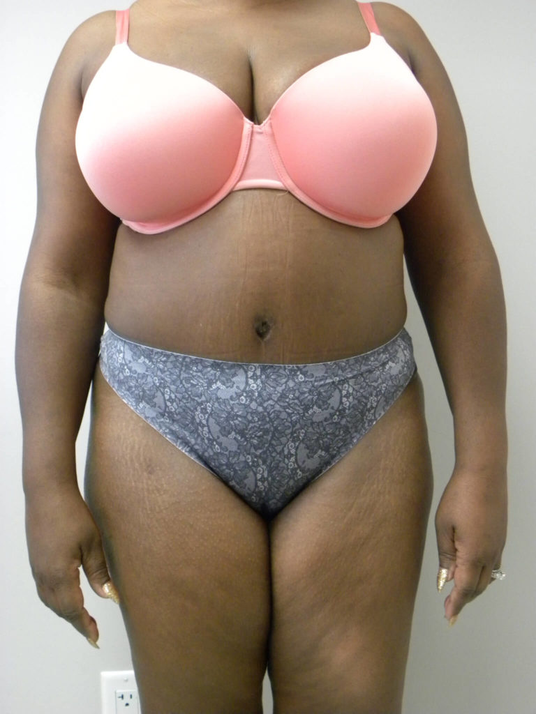 Tummy Tuck Before and After Pictures Miami, FL