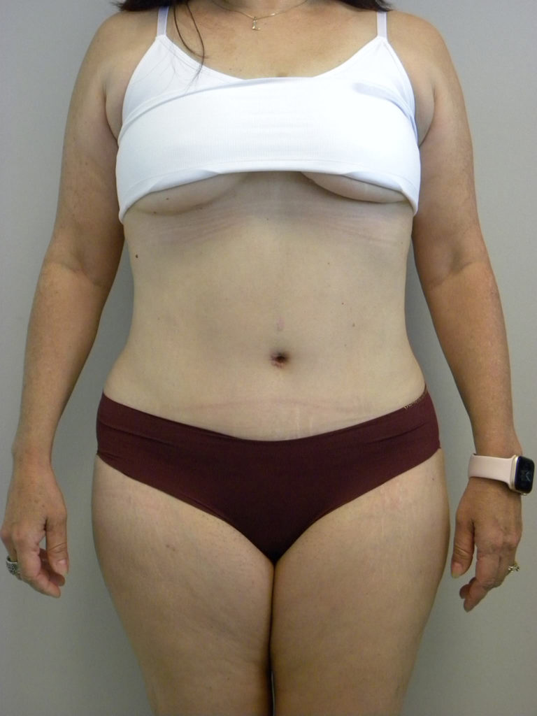 Tummy Tuck Before and After Pictures Miami, FL