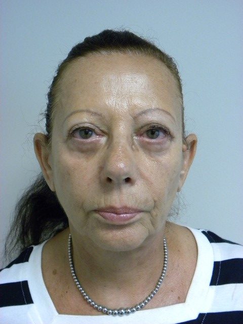 Facelift Before and After Pictures in Miami, FL