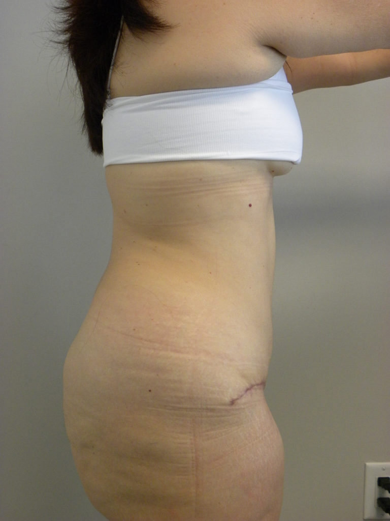 Tummy Tuck Before and After Pictures Miami, FL