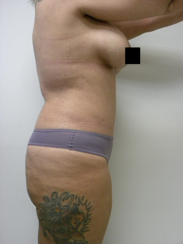 Tummy Tuck Before and After Pictures in Miami, FL