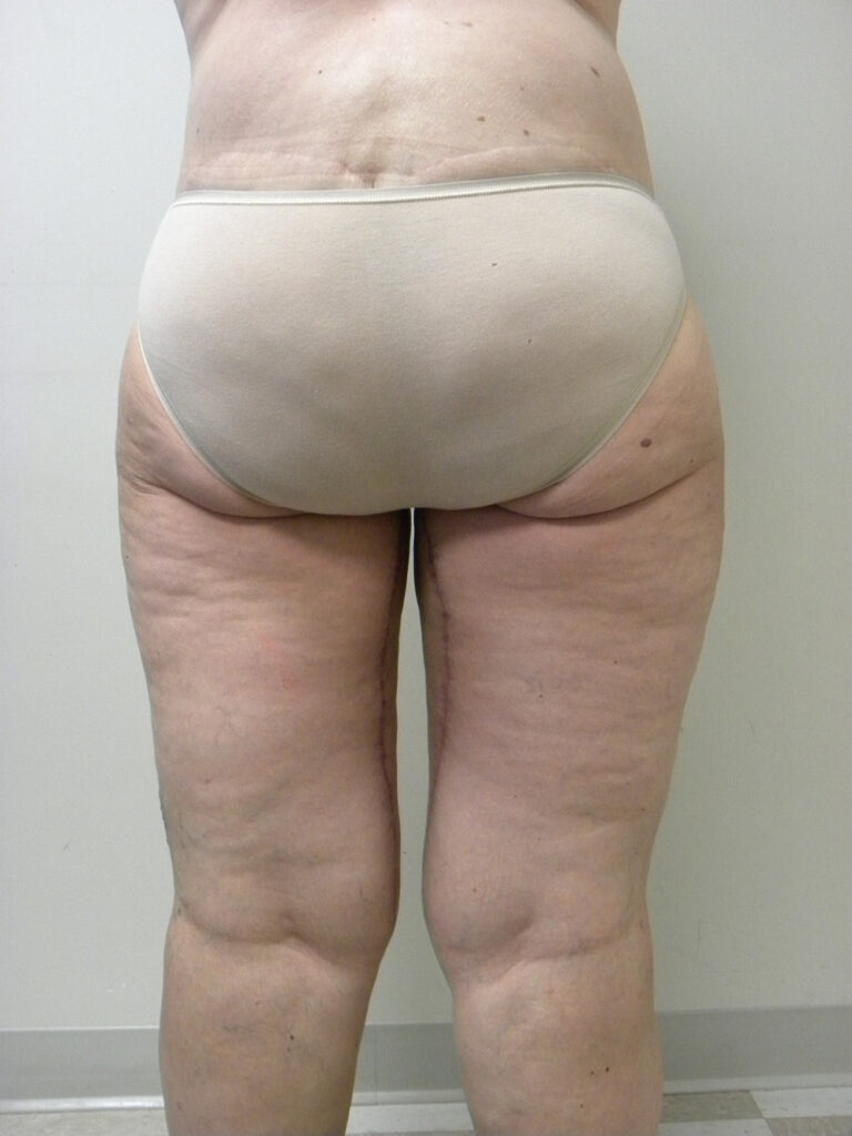 Thigh Lift Before and After Pictures in Miami, FL