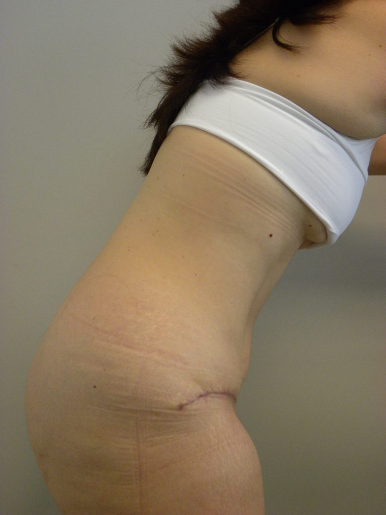 Tummy Tuck Before and After Pictures Miami, FL