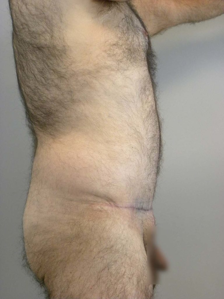 Plastic Surgery Before and After Pictures in Miami, FL - Dr. Adam J. Rubinstein 