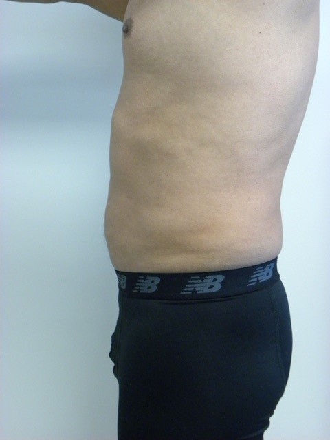 LIPOSUCTION BEFORE AND AFTER PICTURES IN MIAMI, FL