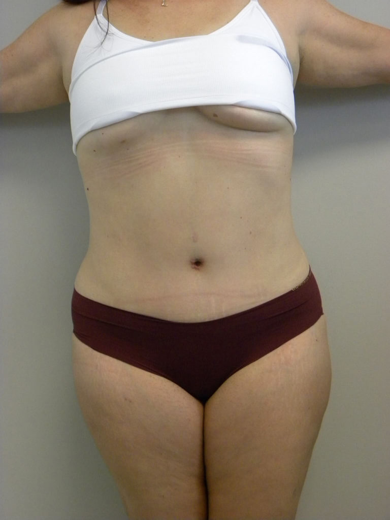 Tummy Tuck Before and After Pictures Miami, FL