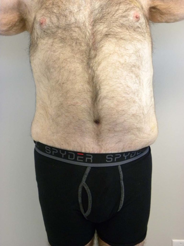 Tummy Tuck Before and After Pictures in Miami, FL