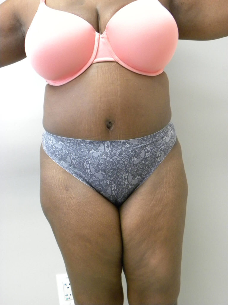 Tummy Tuck Before and After Pictures Miami, FL