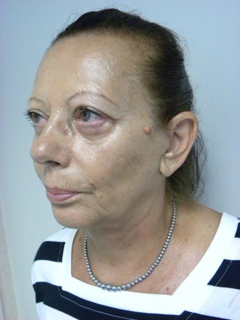 Facelift Before and After Pictures in Miami, FL