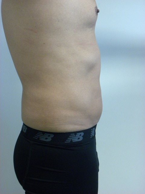 LIPOSUCTION BEFORE AND AFTER PICTURES IN MIAMI, FL