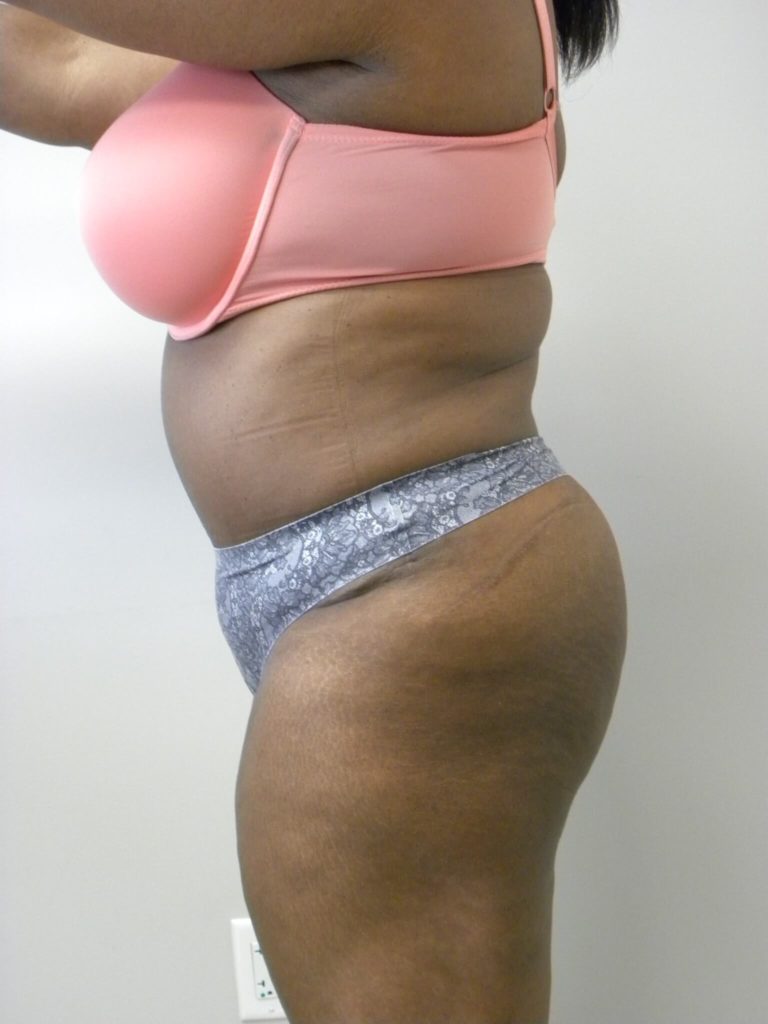 Tummy Tuck Before and After Pictures Miami, FL