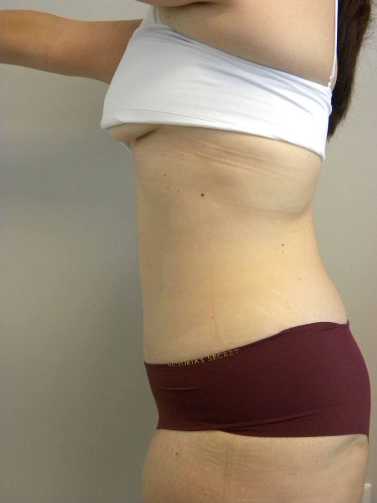 Tummy Tuck Before and After Pictures Miami, FL