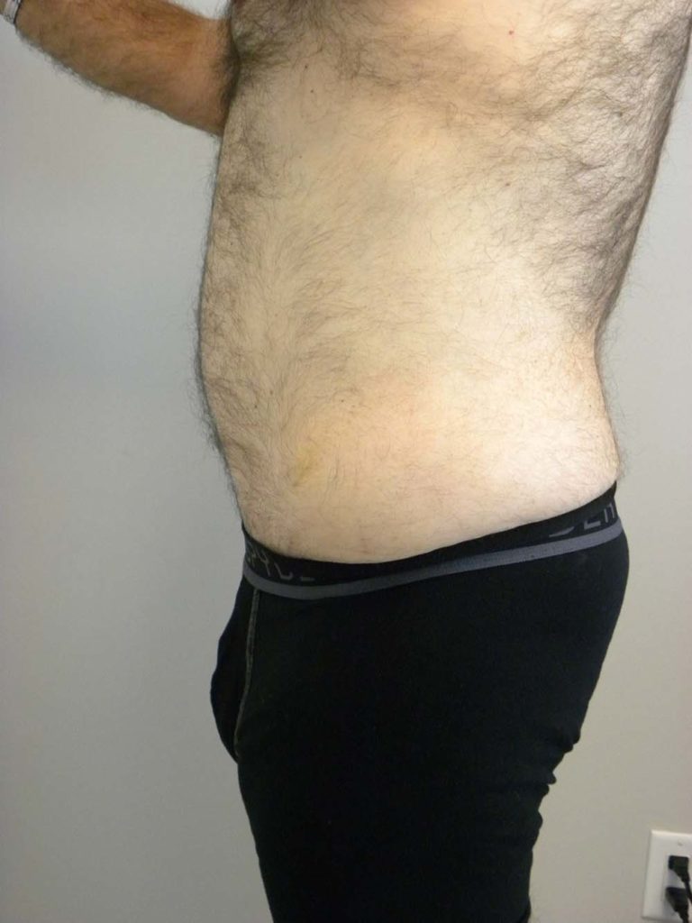 Tummy Tuck Before and After Pictures in Miami, FL