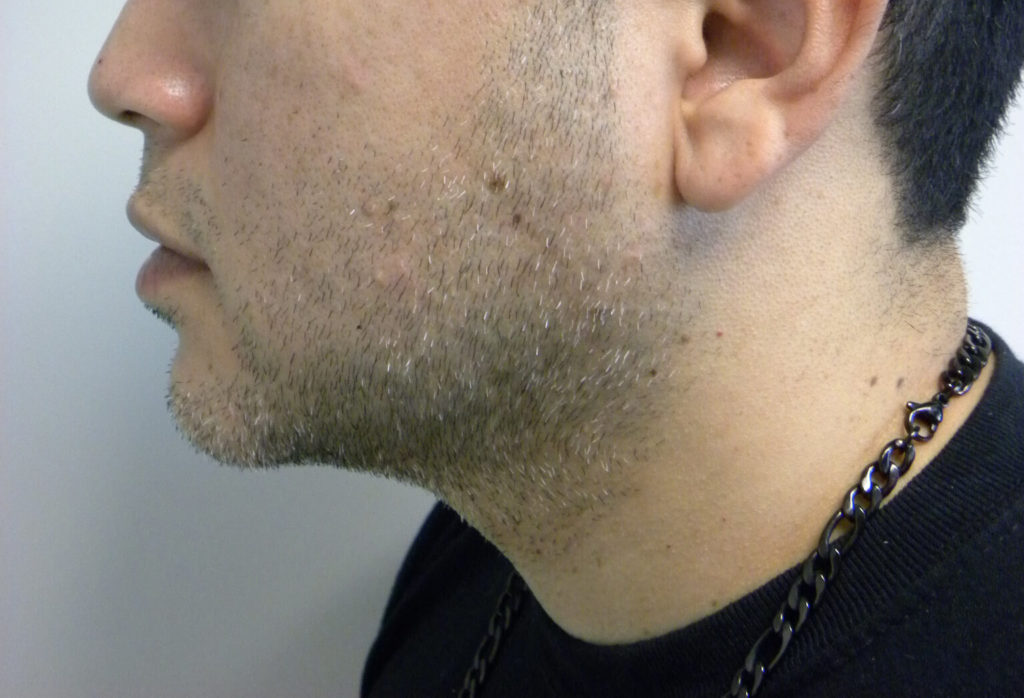 CHIN IMPLANT BEFORE AND AFTER PICTURES IN MIAMI, FL