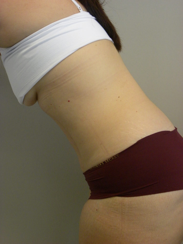 Tummy Tuck Before and After Pictures Miami, FL