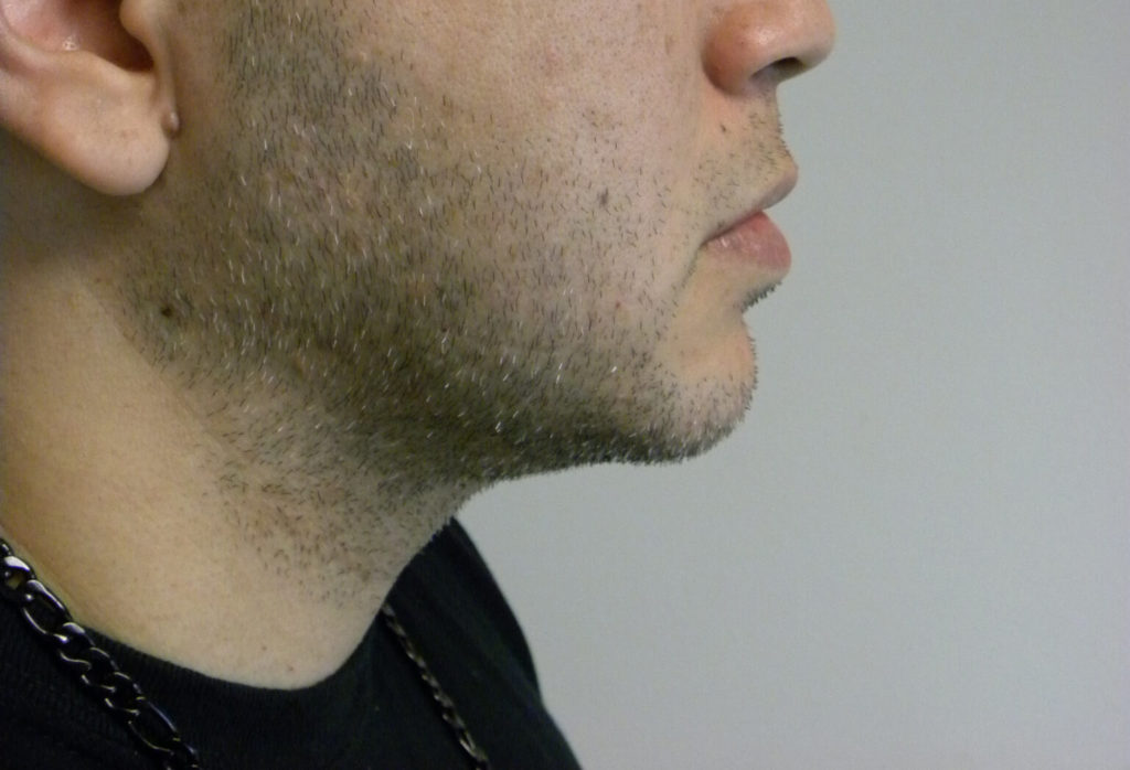 CHIN IMPLANT BEFORE AND AFTER PICTURES IN MIAMI, FL