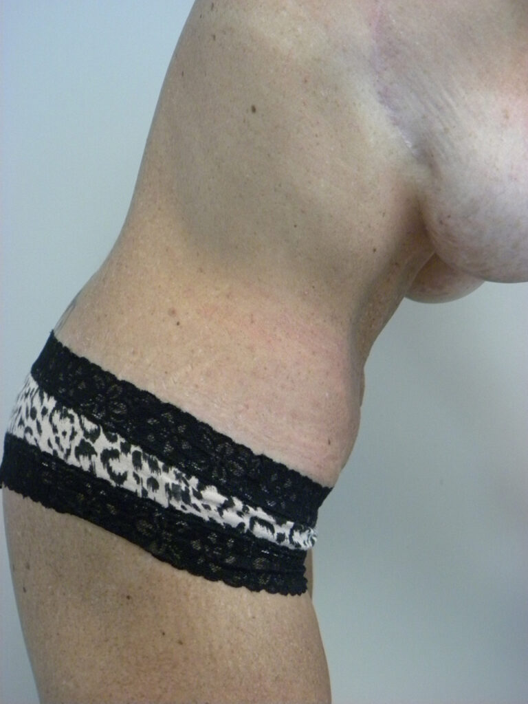Plastic Surgery Before and After Pictures in Miami, FL - Dr. Adam J. Rubinstein 