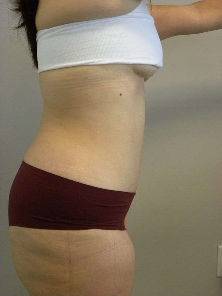 Tummy Tuck Before and After Pictures Miami, FL