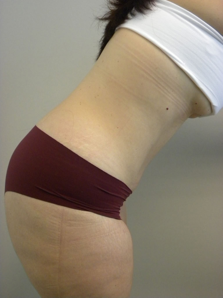 Tummy Tuck Before and After Pictures Miami, FL