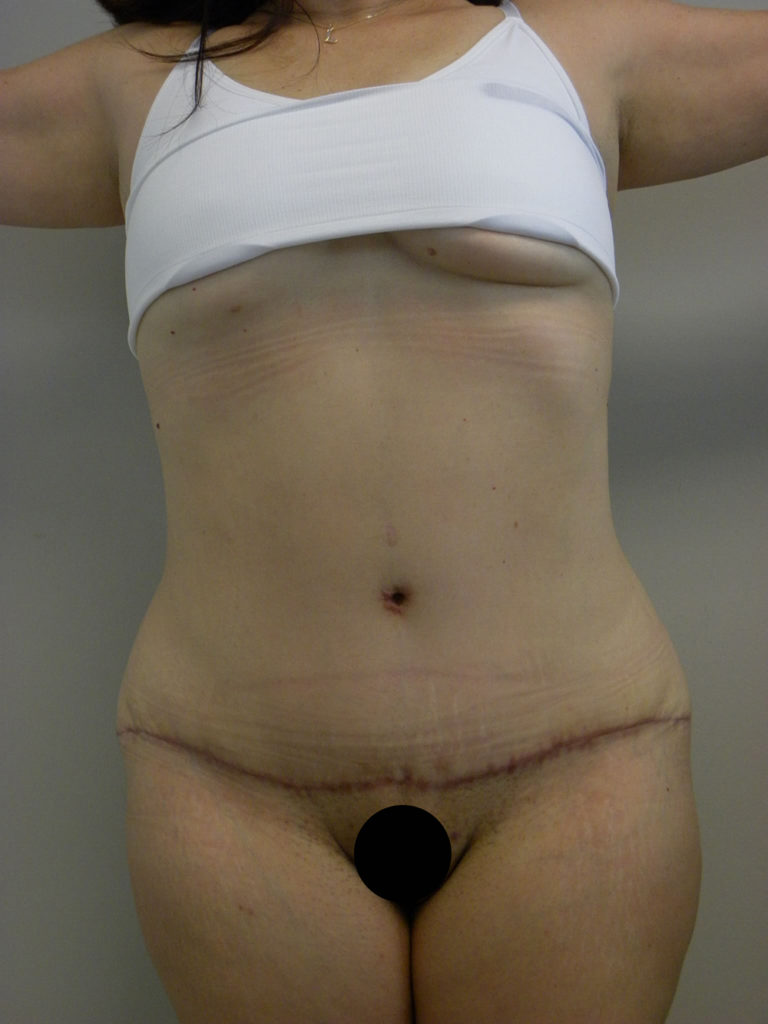 Tummy Tuck Before and After Pictures Miami, FL