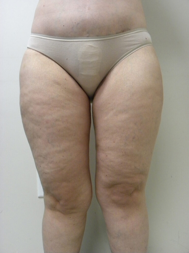 Thigh Lift Before and After Pictures in Miami, FL