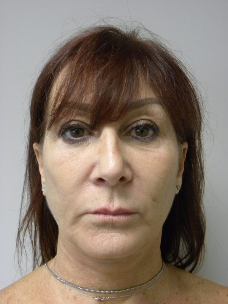 Facelift Before and After Pictures in Miami, FL