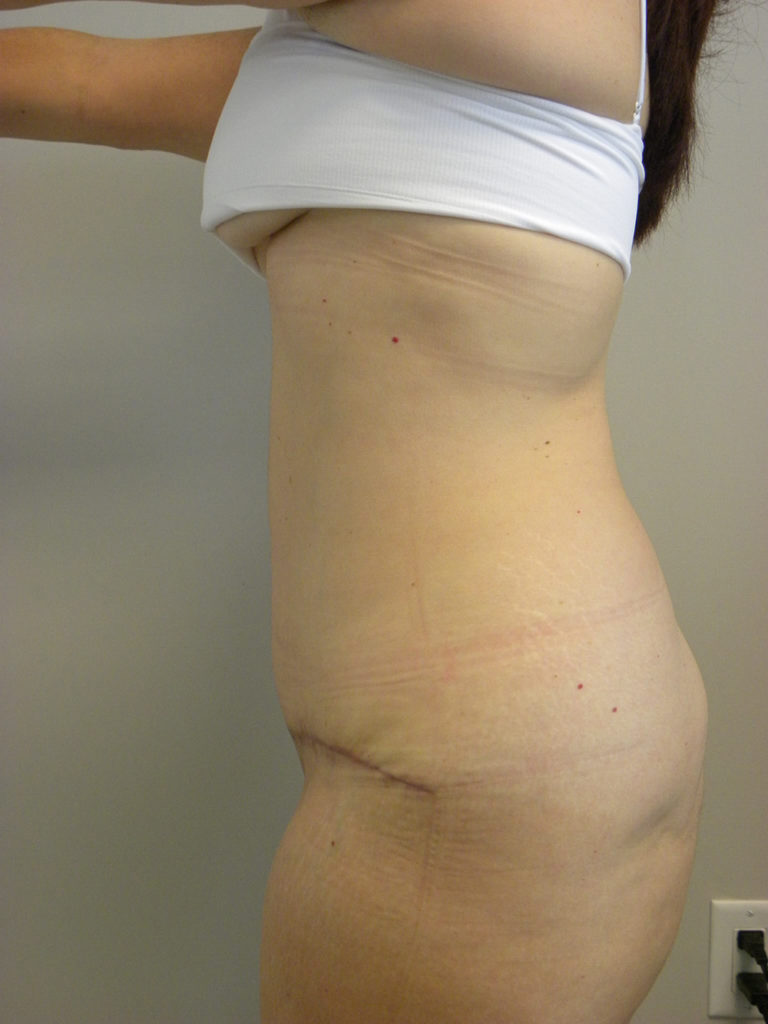 Tummy Tuck Before and After Pictures Miami, FL