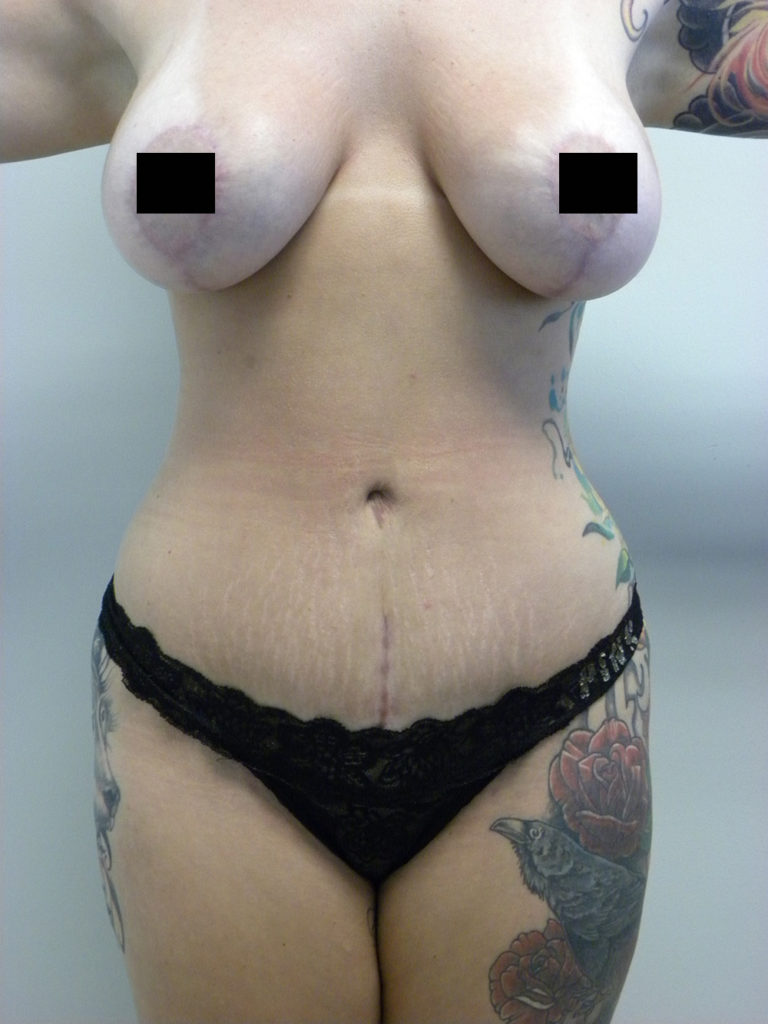 Tummy Tuck Before and After Pictures Miami, FL