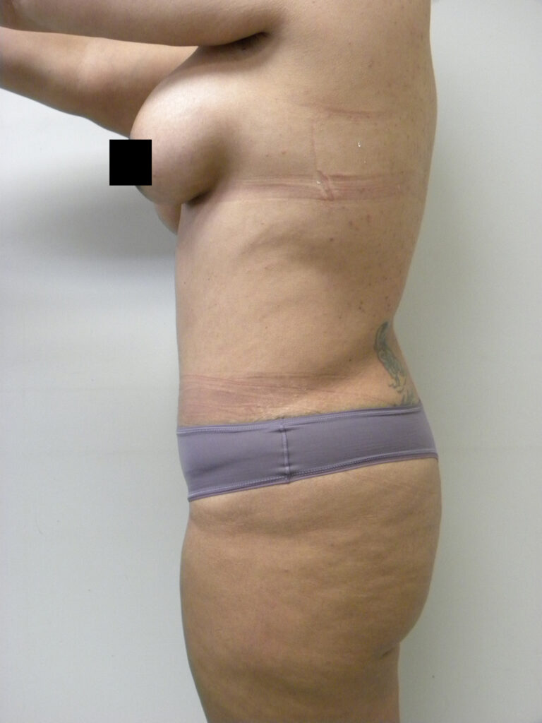 Tummy Tuck Before and After Pictures in Miami, FL