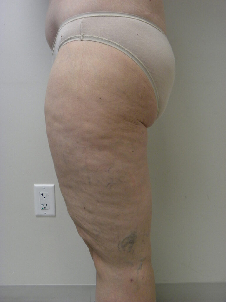 Thigh Lift Before and After Pictures in Miami, FL