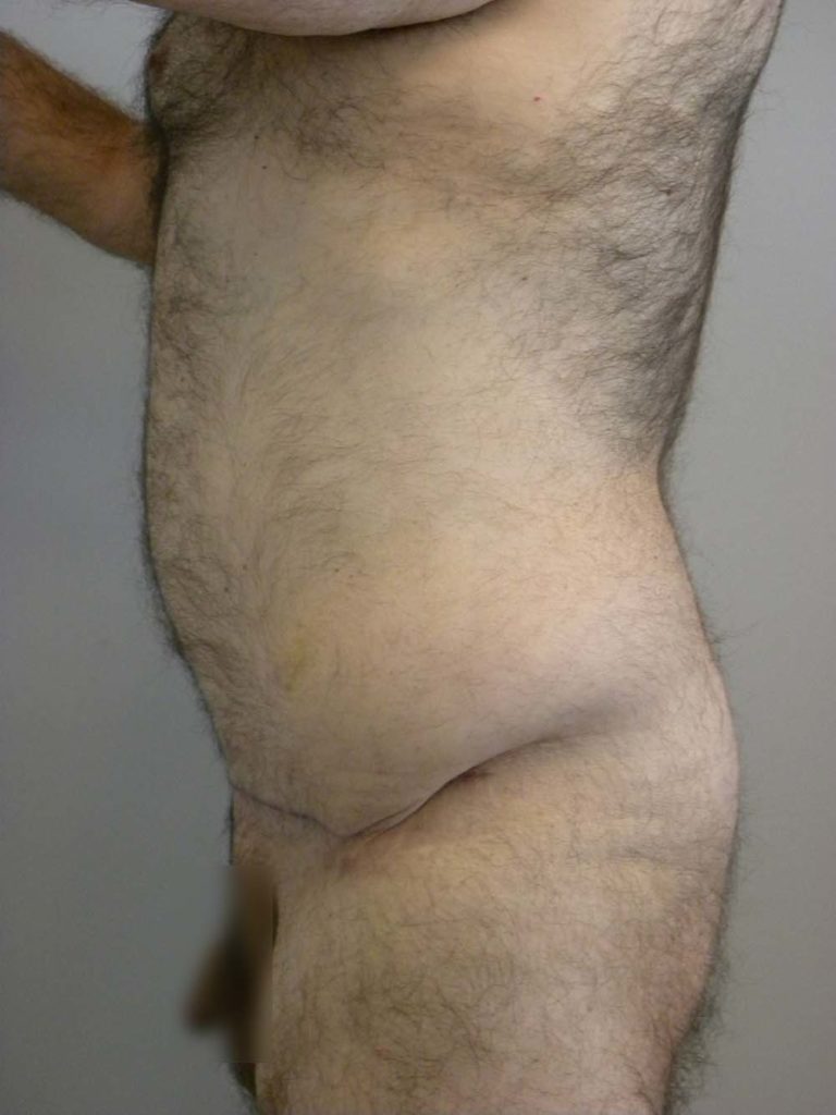 Tummy Tuck Before and After Pictures in Miami, FL