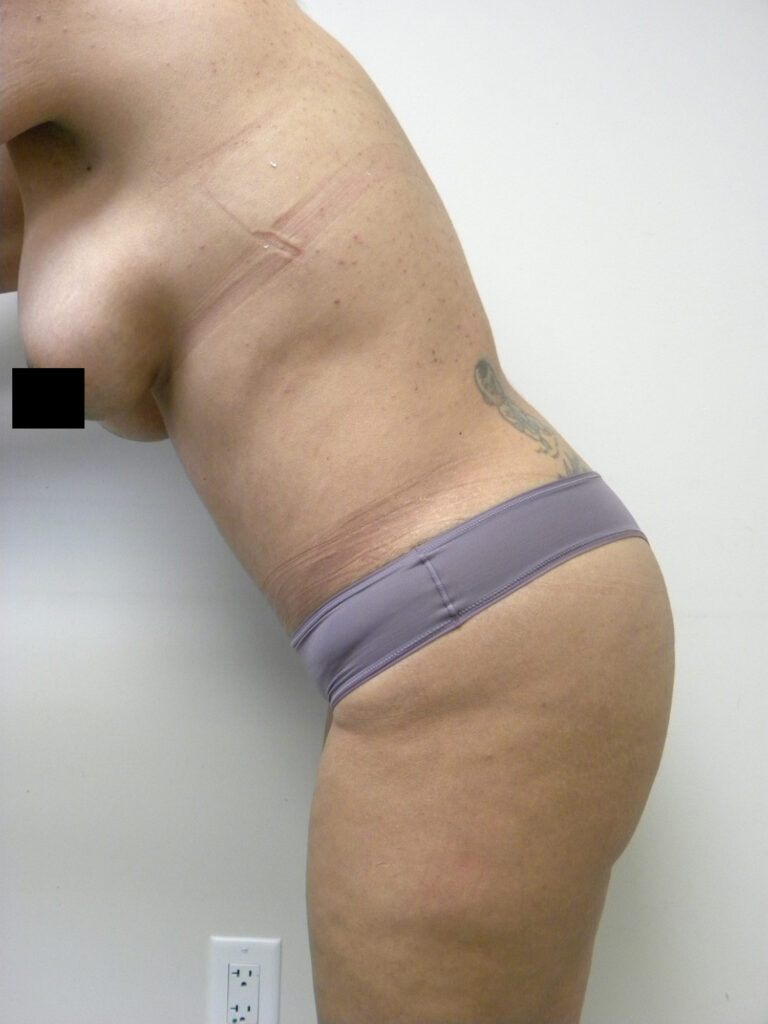 Tummy Tuck Before and After Pictures in Miami, FL