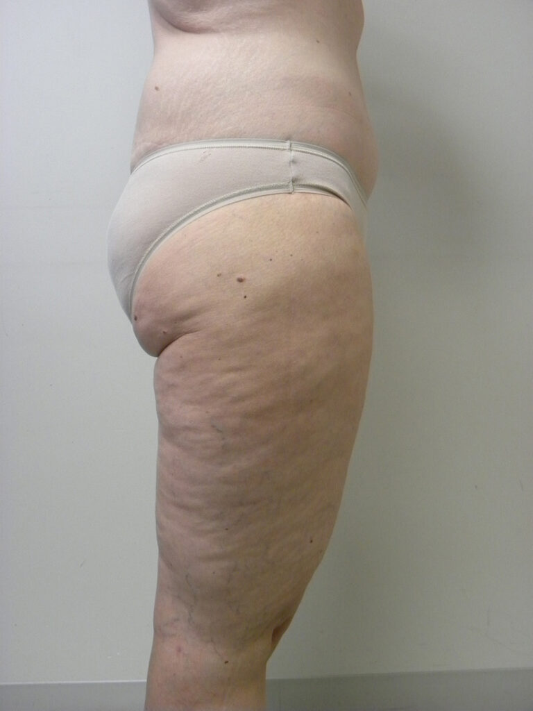 Thigh Lift Before and After Pictures in Miami, FL