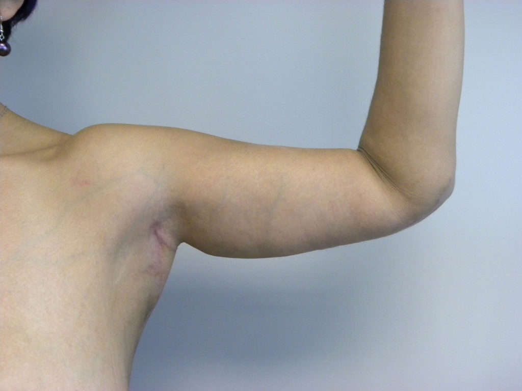 Arm Lift Before and After Pictures Miami, FL