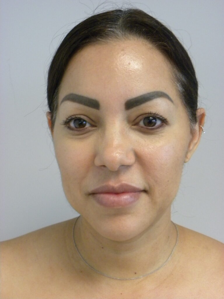 MINIMALLY INVASIVE NECK LIFT WITH ELLEVATE BEFORE AND AFTER PICTURES IN MIAMI, FL