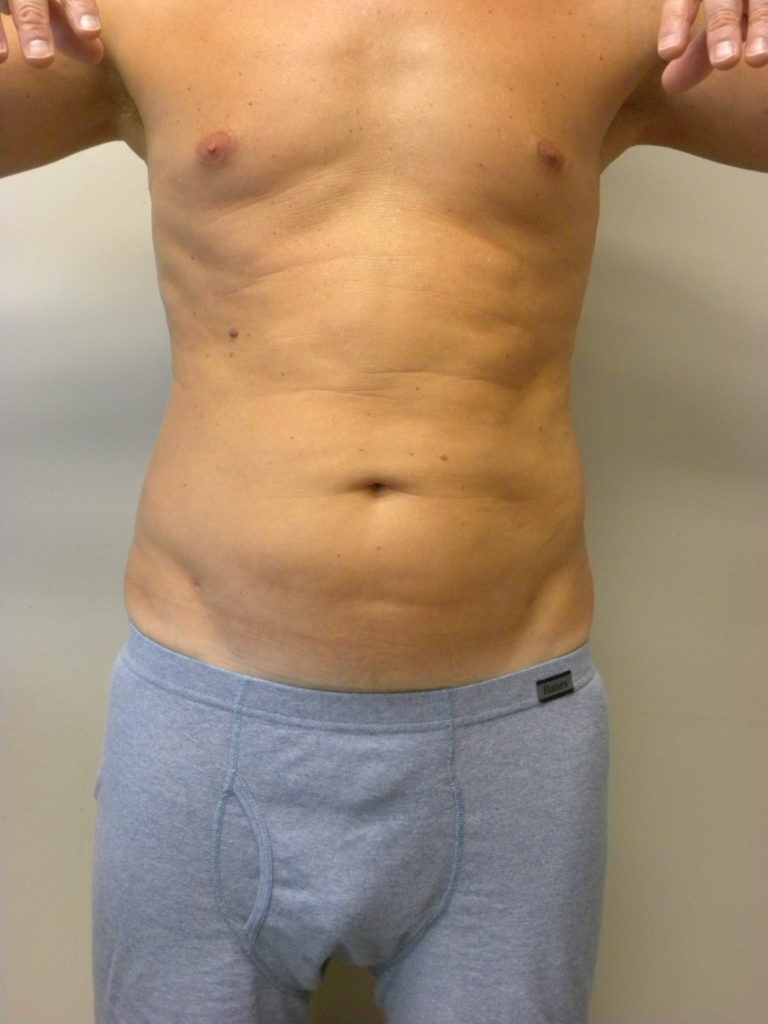 LIPOSUCTION BEFORE AND AFTER PICTURES IN MIAMI, FL